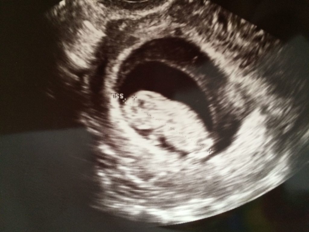 ein Ultraschallbild eines Embryos